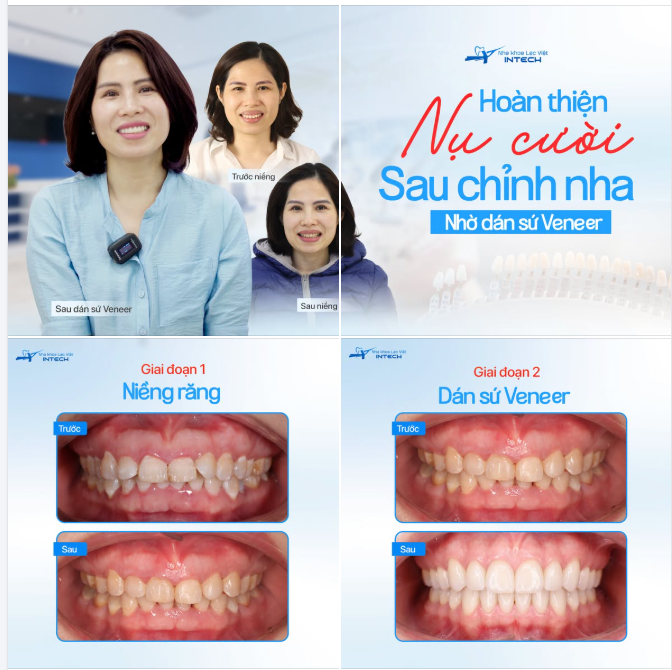 HOÀN THIỆN NỤ CƯỜI SAU CHỈNH NHA VỚI DÁN SỨ VENEER