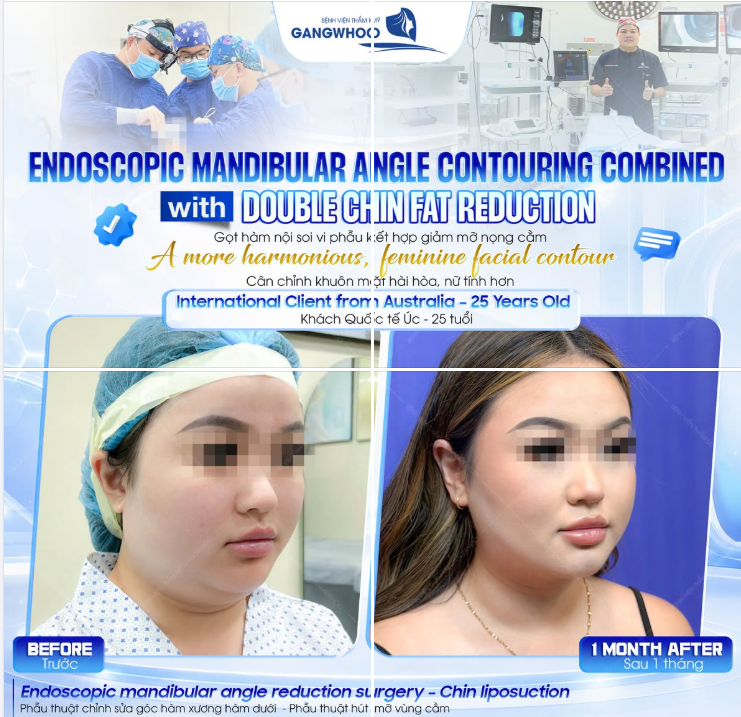 "Mình không ghét gương mặt của mình, chỉ là mỗi lần chụp ảnh lại vô thức tìm góc để che đi phần hàm và nọng cằm..." – chia sẻ của cô khách 25 tuổi đến từ Úc.