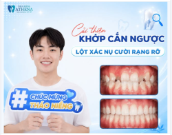 LỘT XÁC NỤ CƯỜI – THAY ĐỔI DIỆN MẠO CÙNG ATHENA!