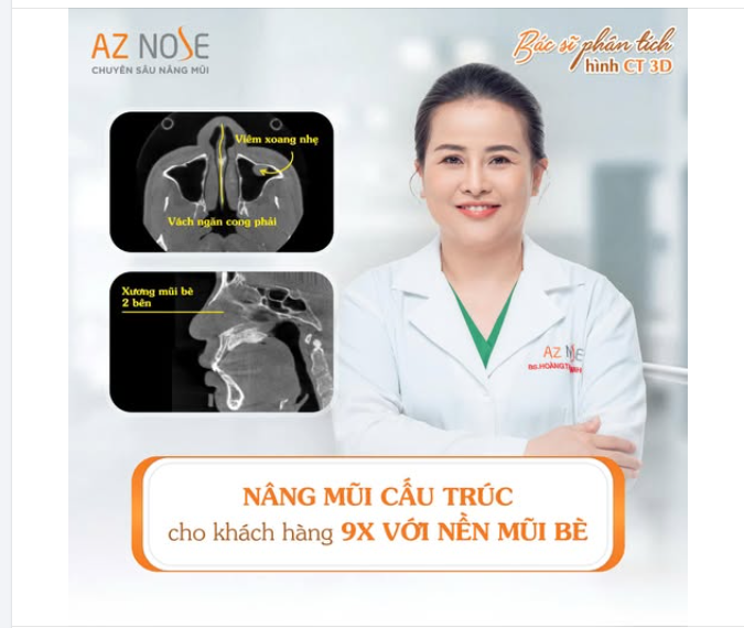 Xử lý nền mũi bè cho khách hàng 9X với mong muốn dáng mũi Lline cao vừa - đầu mũi thon gọn.