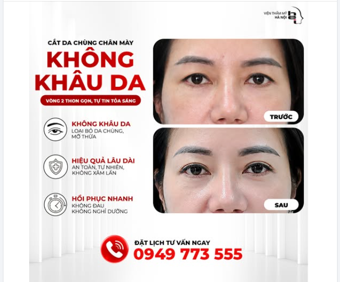 CẮT DA CHÙNG CHÂN MÀY KHÔNG KHÂU DA: GIẢI CỨU ĐÔI MẮT SỤP MÍ – LẤY LẠI 10 NĂM TUỔI XUÂN