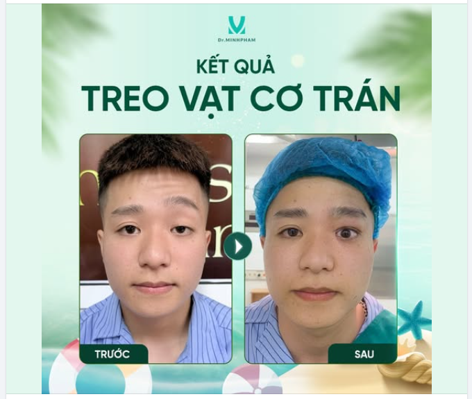 Bạn Trọng Đạt trước khi đến với Dr. Minh Phạm có tình trạng sụp mi mắt trái