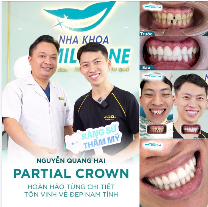 PARTIAL CROWN x QUANG HAI