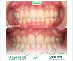 Nhìn qua trường hợp này, có phải bạn nghĩ: "Răng cũng đều rồi mà, niềng làm gì nữa?"