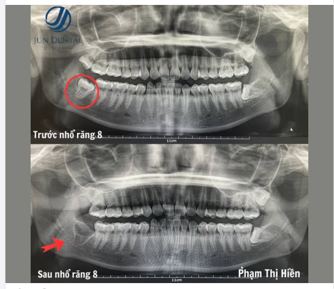 RĂNG KHÔN MỌC NGẦM – ĐỪNG ĐỢI ĐAU MỚI XỬ LÝ!