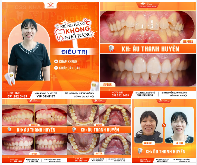 TẠM BIỆT HÀM RĂNG KHẤP KHỂNH CÙNG NIỀNG RĂNG KHÔNG NHỔ RĂNG!