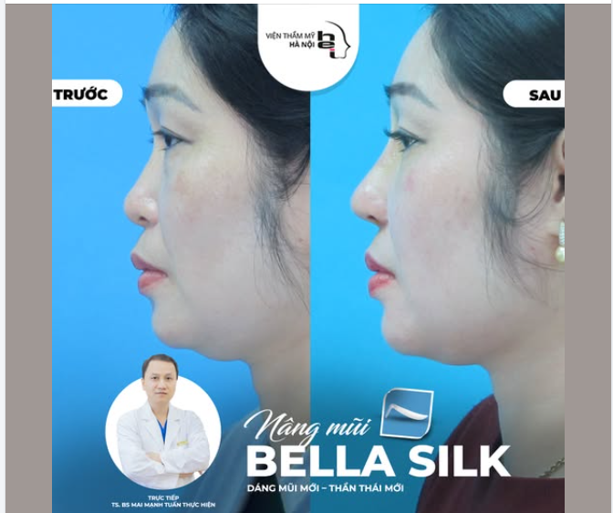 NÂNG MŨI THỜI CÔNG NGHỆ 3D: BIẾT TRƯỚC KẾT QUẢ – XÓA BỎ NỖI LO "HÊN XUI"