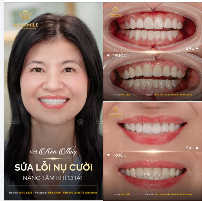 Dáng răng Oval tự nhiên mềm mại, rìa cắn được bo nhẹ tinh tế, xoá tan cảm giác thô cứng trước đó
