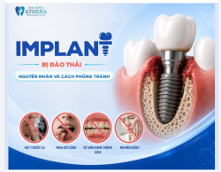 IMPLANT BỊ ĐÀO THẢI: NGUYÊN NHÂN CÁCH PHÒNG TRÁNH