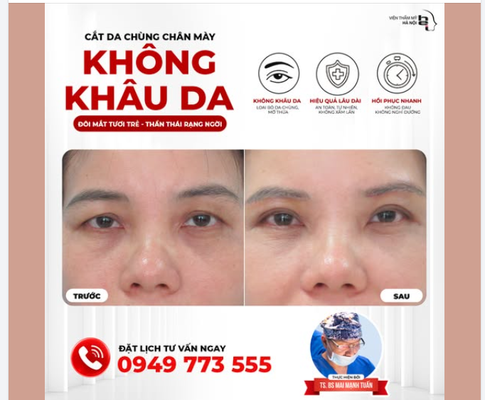 CẮT CHÙNG DA CHÂN MÀY: XOÁ SỤP MÍ LÃO HÓA – KIẾN TẠO TƯỚNG MẠO PHÚ QUÝ