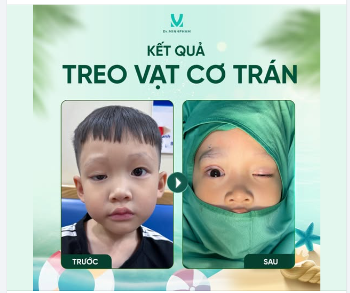 ÁNH NHÌN TỎA SÁNG SAU TREO VCT