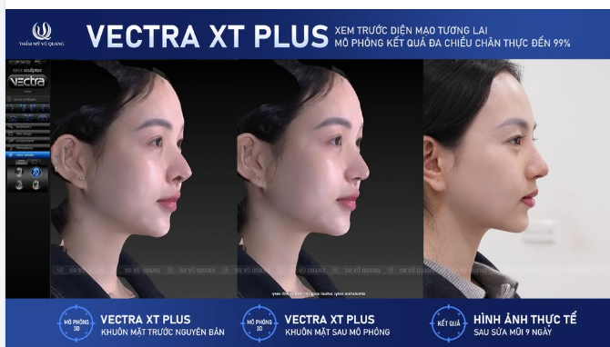 VECTRA XT PLUS: MŨI ĐẸP LÀ MŨI CHUẨN TỶ LỆ VÀNG