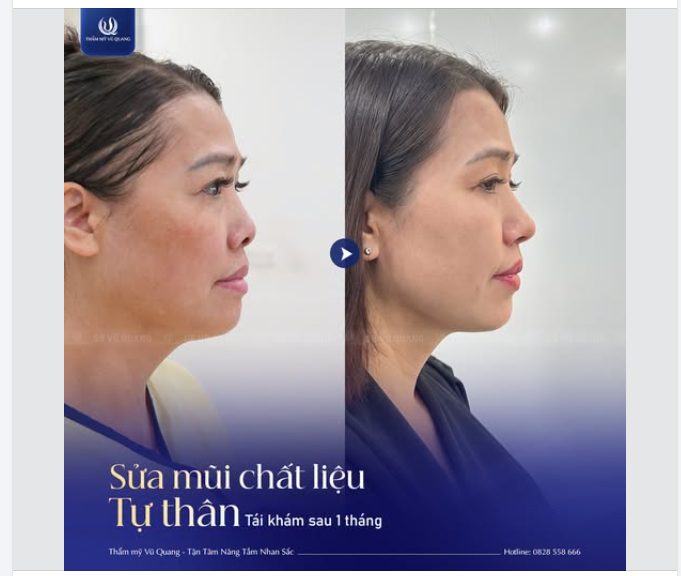 Đổi dáng mũi - Sáng bừng cả gương mặt!