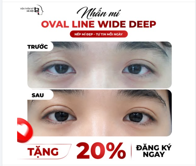 NHẤN MÍ OVAL LINE WIDE DEEP