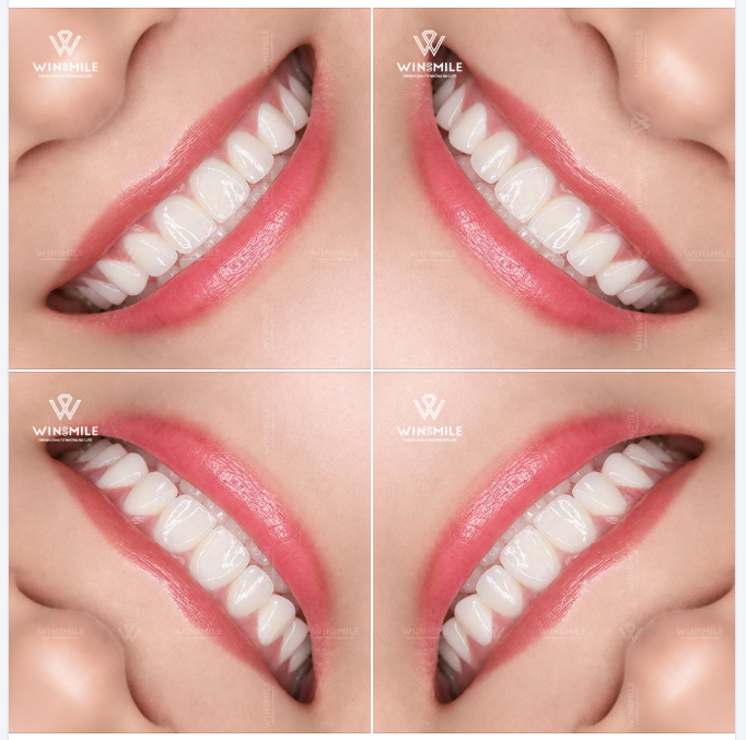 Bạn định nghĩa thế nào là một nụ cười "trẻ hóa"?