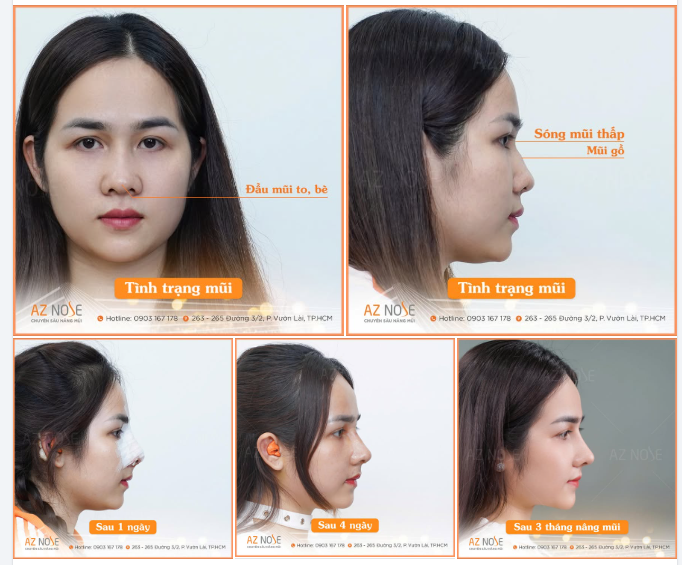 Một thay đổi nhỏ trên dáng mũi – một diện mạo mới đầy tự tin.