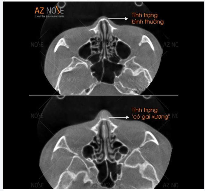 Phát hiện khách hàng có "gai màng xương" sau nâng mũi khi chụp CT3D