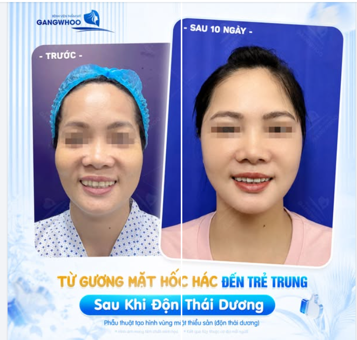 TỪ GƯƠNG MẶT HỐC HÁC ĐẾN TRẺ TRUNG SAU KHI ĐỘN THÁI DƯƠNG