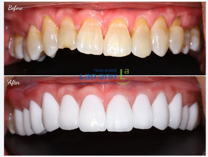 Men răng xỉn, rìa cắn mẻ, Cười thôi cũng thấy ngại ngần. Veneer mài ít, dán nhanh, Nụ cười bừng sáng, tự tin mỗi ngày