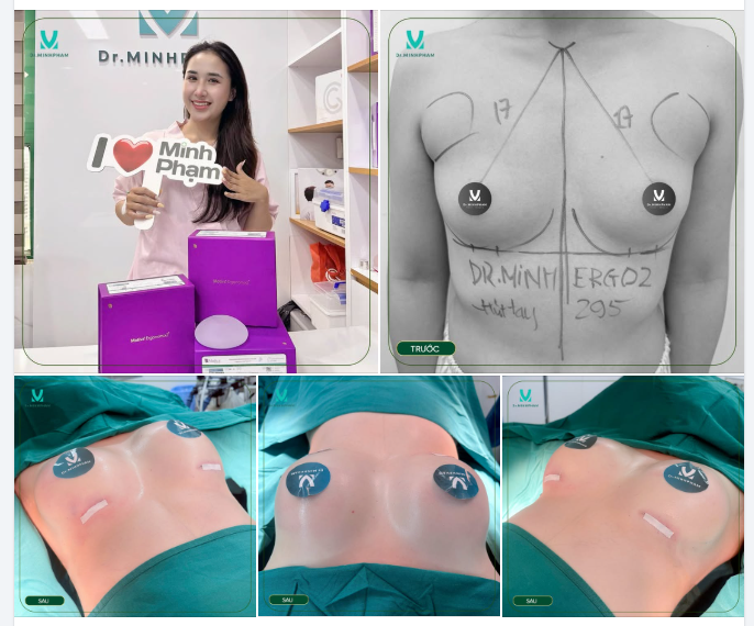 Từ tình trạng V1 teo lép, ít mô tuyến, trợ lý bác sĩ Minh đã lựa chọn dòng túi Ergonomix2 để nâng cấp vòng 1, hướng đến dáng ngực mềm mại và hài hòa với vóc dáng.