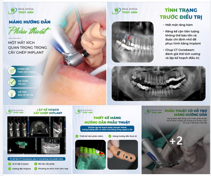 MÁNG HƯỚNG DẪN PHẪU THUẬT – MỘT MẮT XÍCH QUAN TRỌNG TRONG CẤY GHÉP IMPLANT