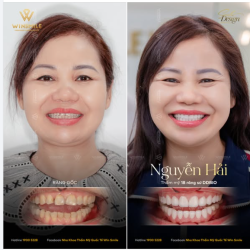 Ở độ tuổi U50, phụ nữ thường đầu tư rất nhiều cho làn da, mái tóc để níu giữ thanh xuân, nhưng lại vô tình quên mất điểm cần tân trang nhất chính là nụ cười