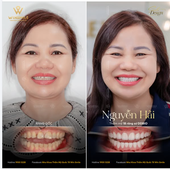Ở độ tuổi U50, phụ nữ thường đầu tư rất nhiều cho làn da, mái tóc để níu giữ thanh xuân, nhưng lại vô tình quên mất điểm cần tân trang nhất chính là nụ cười
