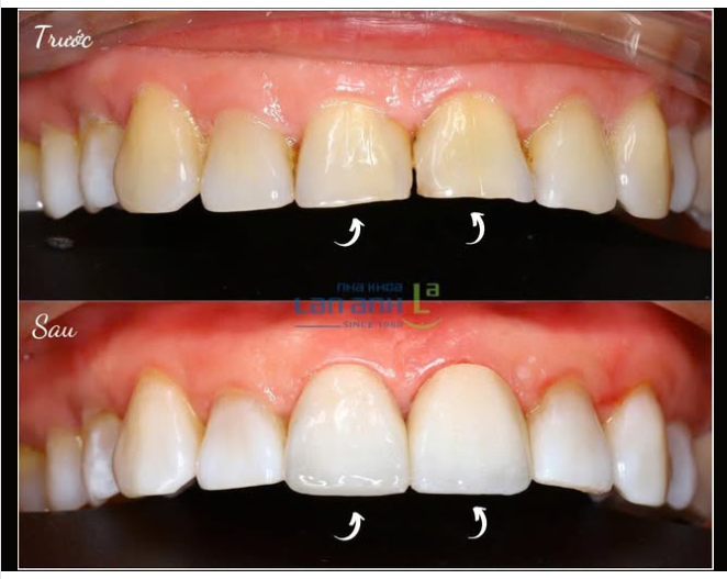 Làm 2 răng sứ, nhưng hiệu quả như nâng cấp cả nụ cười.