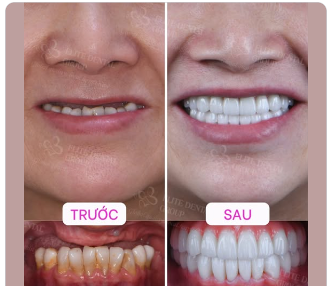TRỒNG LẠI RĂNG MẤT - TÌM LẠI ĐƯỢC CẢ NÉT RẠNG RỠ VÀ NIỀM VUI SỐNG