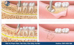 NHỔ RĂNG KHÔN MỌC NGẦM – LOẠI BỎ SỚM, BẢO VỆ RĂNG KẾ CẬN