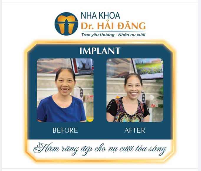 Mất răng không chỉ ảnh hưởng đến việc ăn nhai mà còn khiến nhiều cô chú, anh chị thiếu tự tin khi giao tiếp.