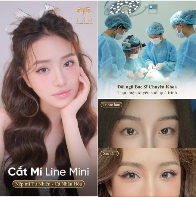Cùng theo dõi kết quả sau 2 tháng Cắt mí Line mini của bạn khách hàng.
