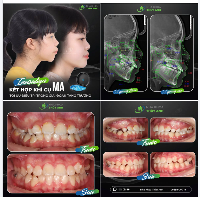 CAN THIỆP SAI KHỚP CẮN HẠNG II TRONG GIAI ĐOẠN TĂNG TRƯỞNG VỚI INVISALIGN KẾT HỢP KHÍ CỤ MA