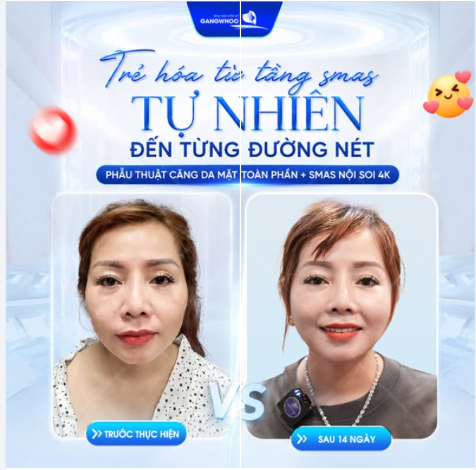 TRẺ HÓA TỪ TẦNG SMAS - TỰ NHIÊN ĐẾN TỪNG ĐƯỜNG NÉT