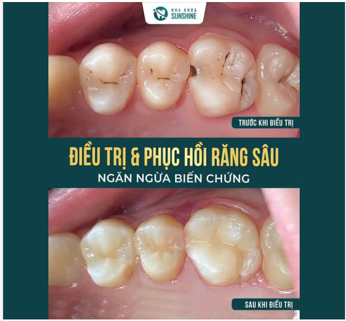 ĐIỀU TRỊ VÀ PHỤC HỒI RĂNG SÂU – NGĂN NGỪA BIẾN CHỨNG