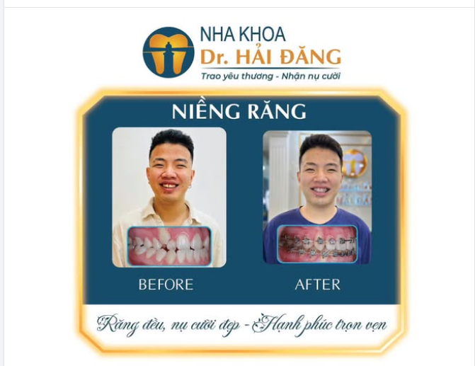 NIỀNG RĂNG – THAY ĐỔI NỤ CƯỜI, THAY ĐỔI SỰ TỰ TIN