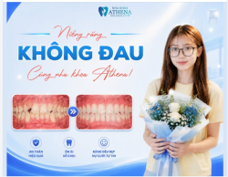 BEFORE / AFTER: TẠM BIỆT RĂNG KHẤP KHỂNH – ĐÓN NỤ CƯỜI TỰ TIN!