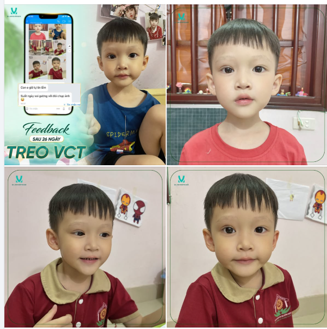FEEDBACK SAU 26 NGÀY TREO VẠT CƠ TRÁN