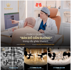 PHIM X-QUANG - "BẢN ĐỒ DẪN ĐƯỜNG" TRONG CẤY GHÉP IMPLANT