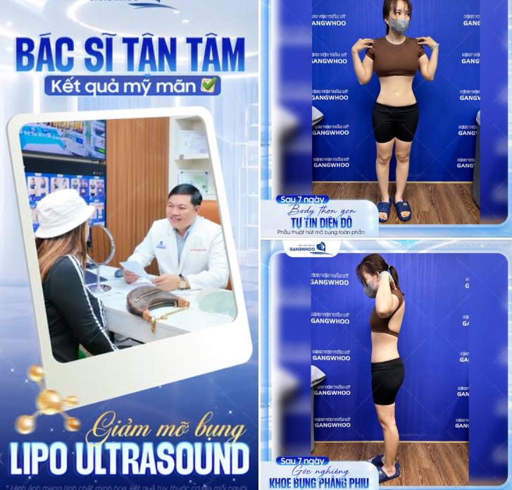 GIẢM MỠ BỤNG TẠI GANGWHOO: BÁC SĨ TẬN TÂM ĐỒNG HÀNH CÙNG KHÁCH HÀNG