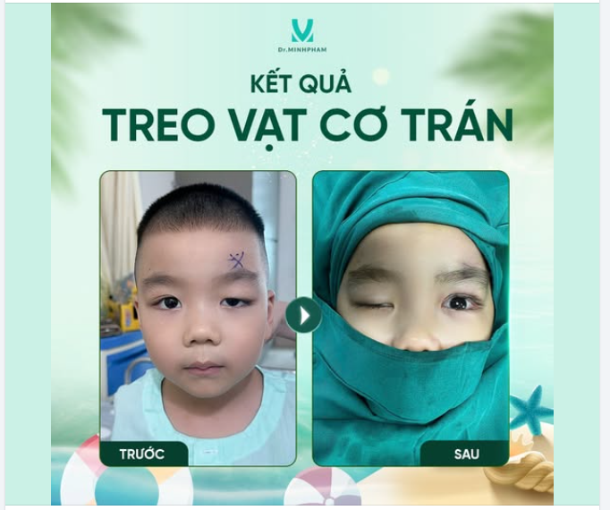 ÁNH NHÌN MỞ RỘNG SAU PHẪU THUẬT SỤP MI
