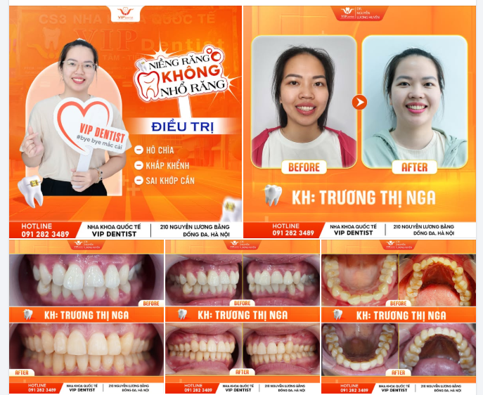 KHẮC PHỤC RĂNG HÔ CHÌA - KHẤP KHỂNH CÙNG NIỀNG KHÔNG NHỔ RĂNG!
