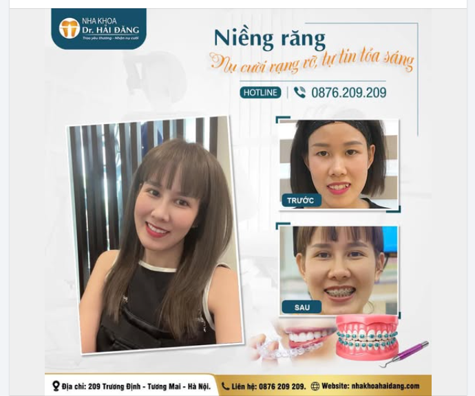 TRƯỚC VÀ SAU KHI NIỀNG - SỰ KHÁC BIỆT KHÔNG CHỈ Ở HÀM RĂNG