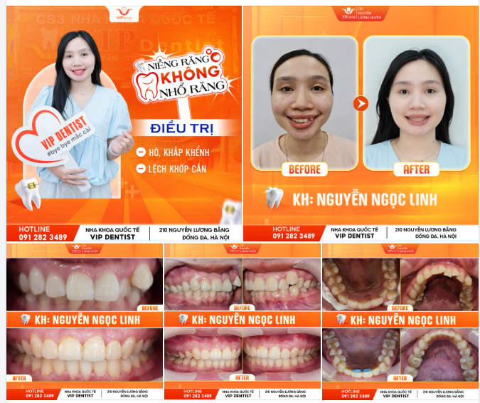 NỤ CƯỜI LỆCH LẠC - E NGẠI - THIẾU TỰ TIN!