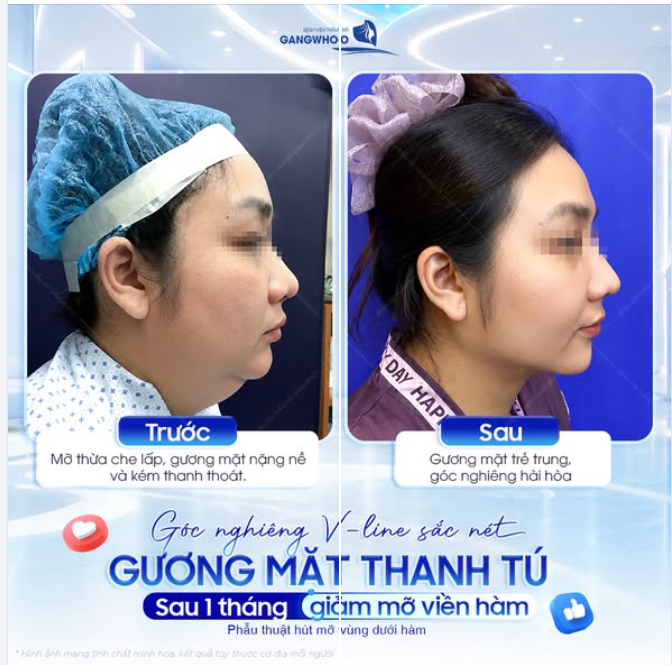 GÓC NGHIÊNG V-LINE SẮC NÉT, GƯƠNG MẶT THANH TÚ