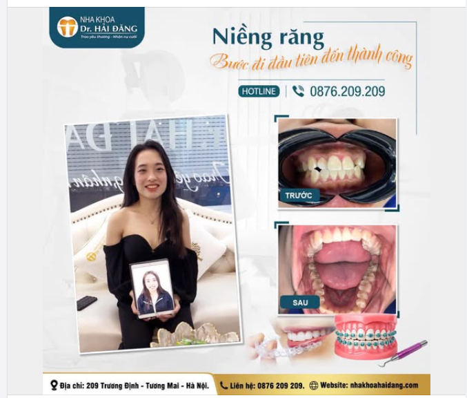NIỀNG RĂNG – BƯỚC ĐI ĐẦU TIÊN ĐẾN NỤ CƯỜI TỰ TIN