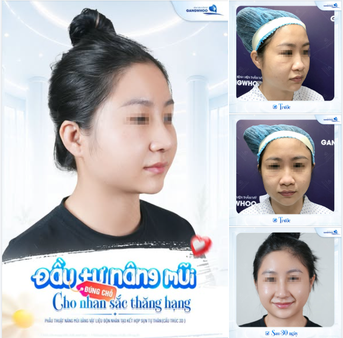 ĐẦU TƯ NÂNG MŨI ĐÚNG CHỖ
