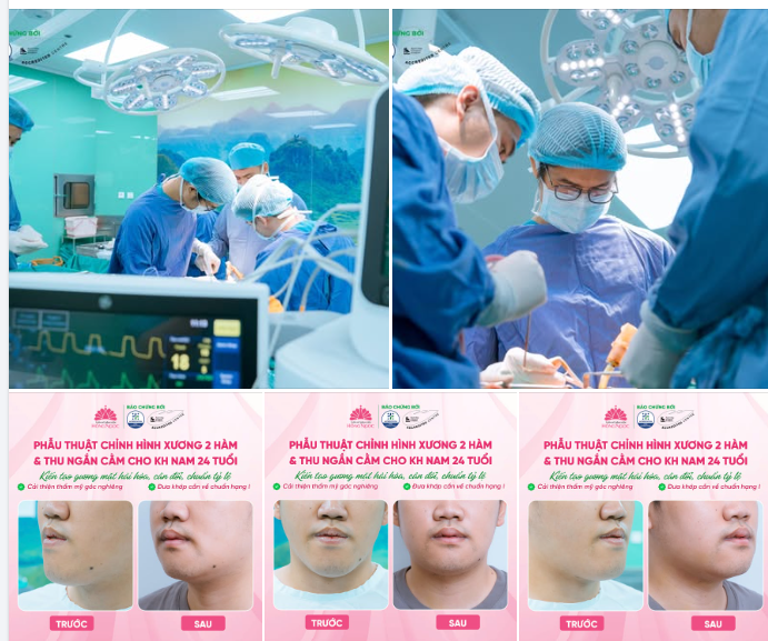 Khớp cắn đã tối ưu nhưng thẩm mỹ khuôn mặt vẫn mất cân đối, chưa hài hòa?