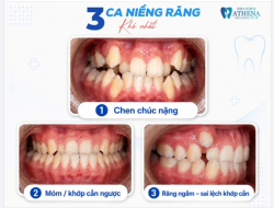 3 TRƯỜNG HỢP NẮN CHỈNH NỤ CƯỜI KHÓ NHẤT – BẠN CÓ ĐANG GẶP PHẢI?