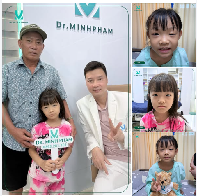 Hình ảnh đôi mắt bé Bảo Hân tái khám sau 1 năm treo mi VCT tại Dr. Minh Phạm